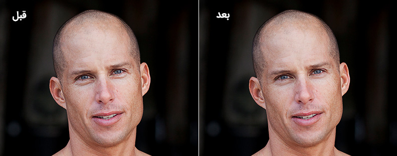 برداشتن چین و چروک از روی صورت